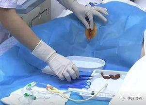 国产导尿视频在线观看,揭秘现代医疗护理技术