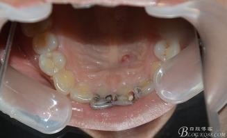 国产氧化锆修复视频大全,全方位解析与实操技巧